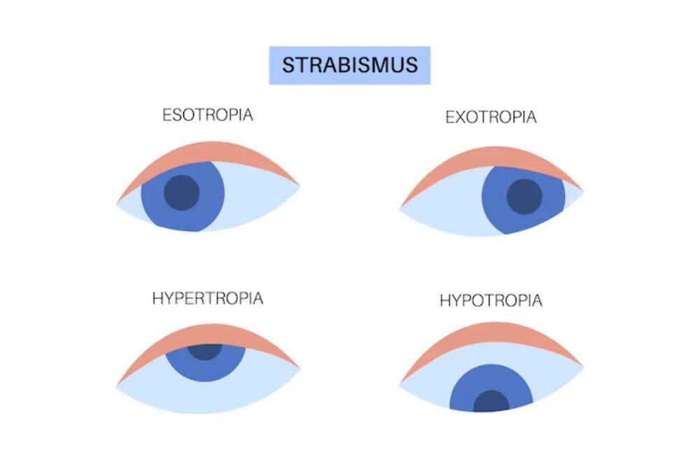 strabismus