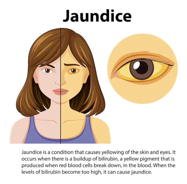 jaundice eye issue