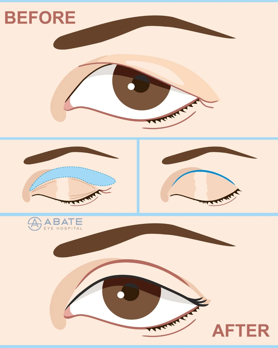 before and after eyelid surgery