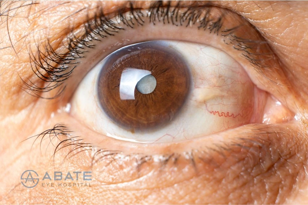 Eye Surgery for Glaucoma: A Guide to Glaucoma Treatment
