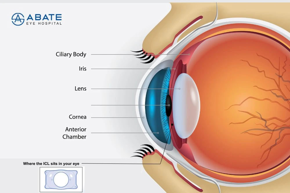 Implantable Collamer Lens : Safe, Reversible Vision Correction