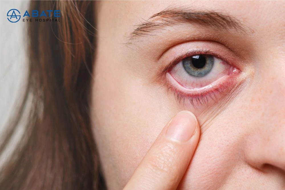 Effective Remedies for Pink Eye: Relief and Care