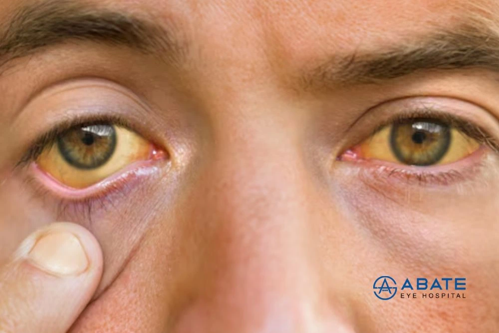 Slightly Yellow Eyes in Adults: Causes, Symptoms and Treatment Guide