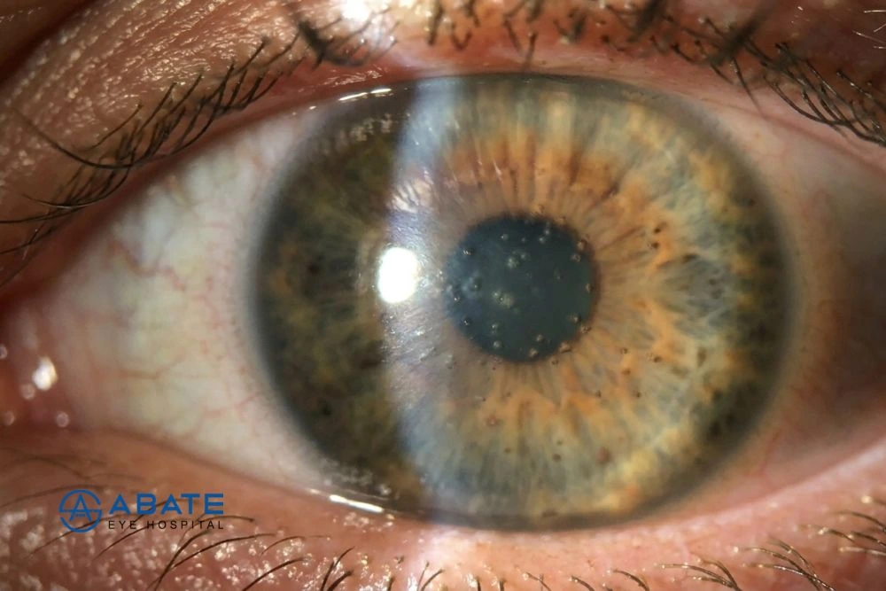 Fuchs’ Dystrophy: Causes, Symptoms, Diagnosis, and Advanced Treatment Options