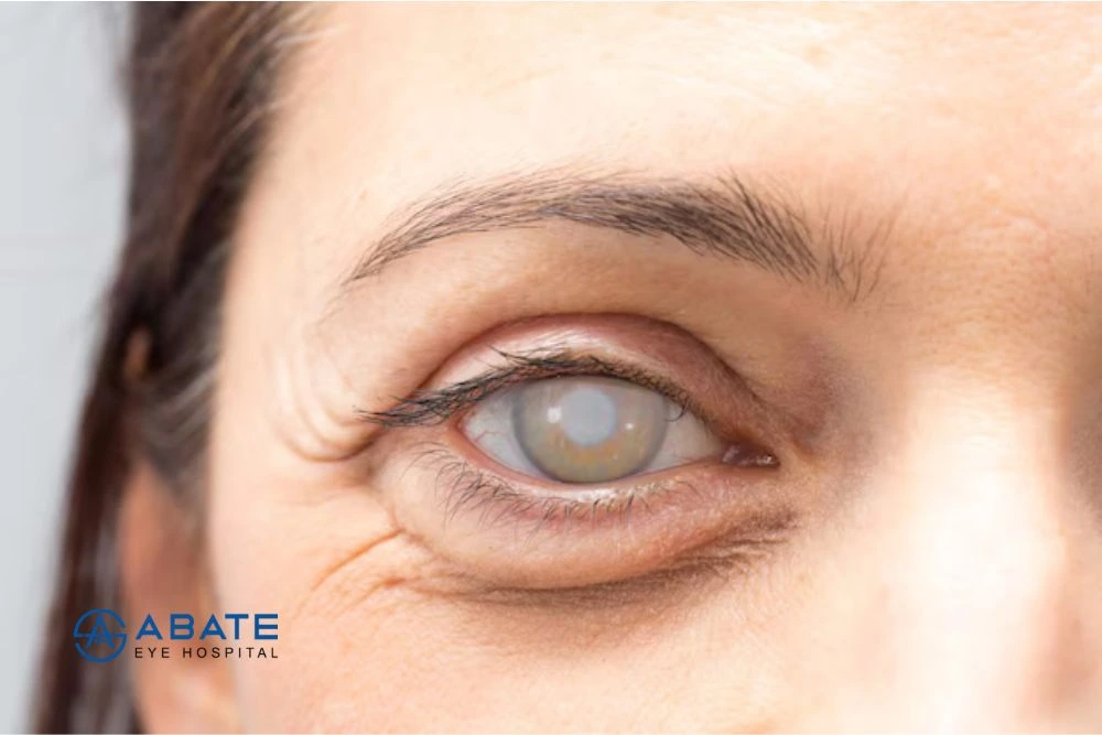 Can Cataract Come Back? Understanding the Truth After Surgery