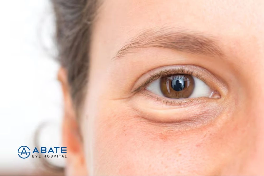 Puffy Eyes: Causes, Remedies, and When to Seek Treatment