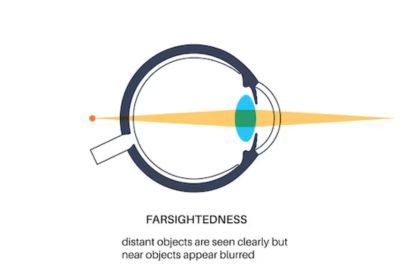 what is farsightedness