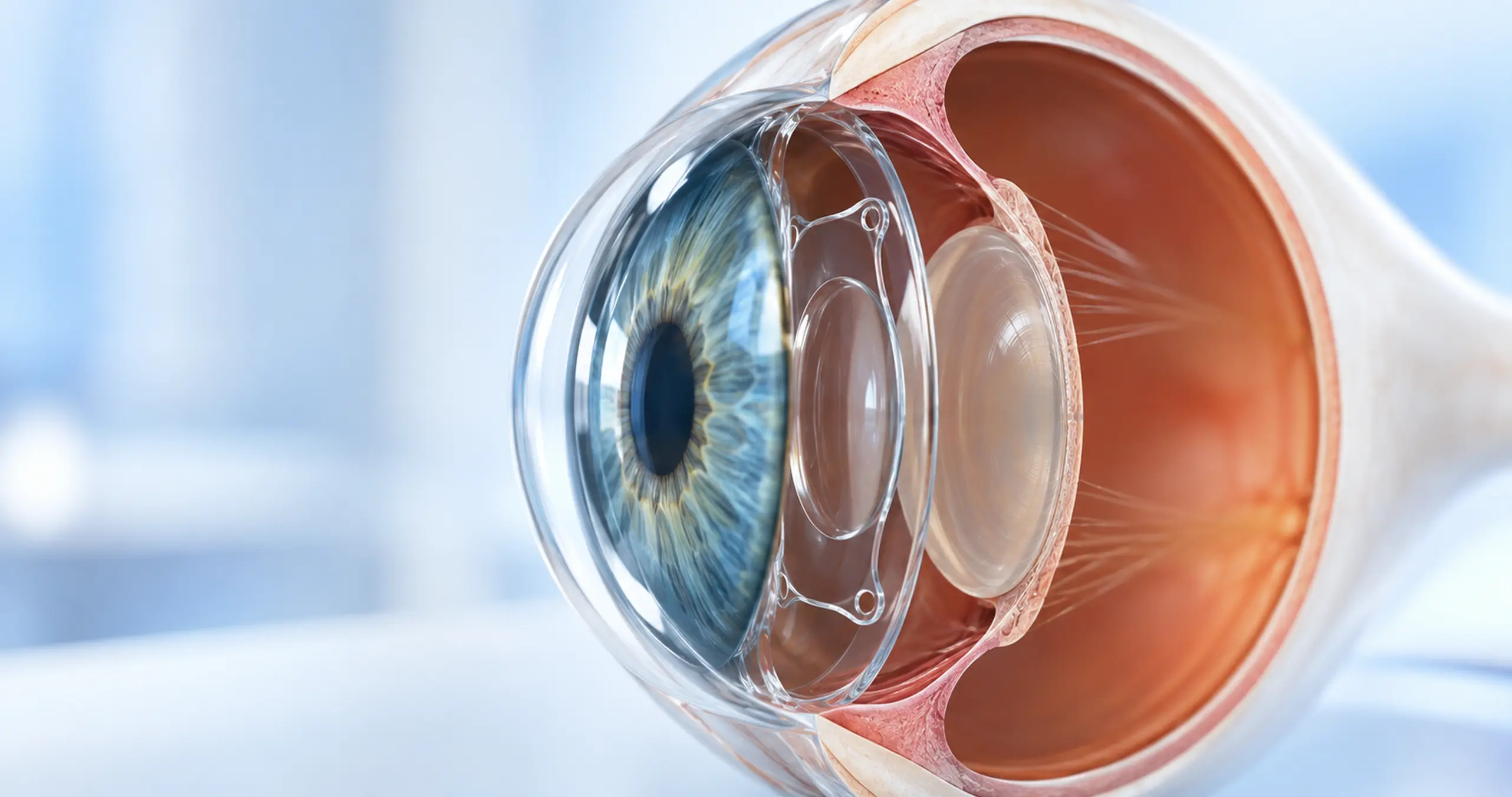 ICL Implantable Collamer Lens surgery in Calicut at Abate