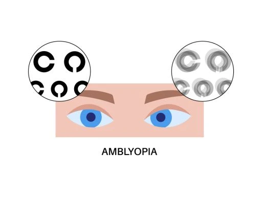 Why Choose Abate Eye Hospital for LASIK Surgery in Calicut?